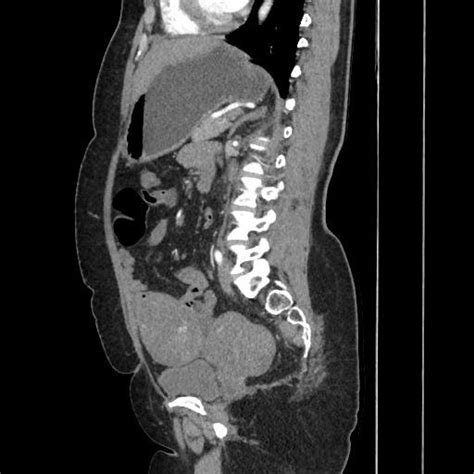 Axial T1 Weighted Mr Image Shows Hypointense Mass Lesions In The Pelvis