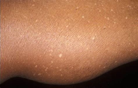 Tiny Black Spots On Skin