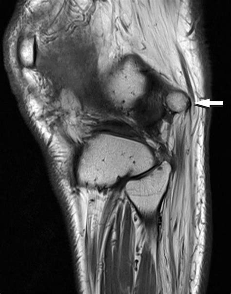 Compression Neuropathy Of The Common Peroneal Nerve By The Fabella