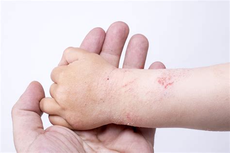 Pediatric Atopic Dermatitis Subtypes May Exist Dermatology Times And