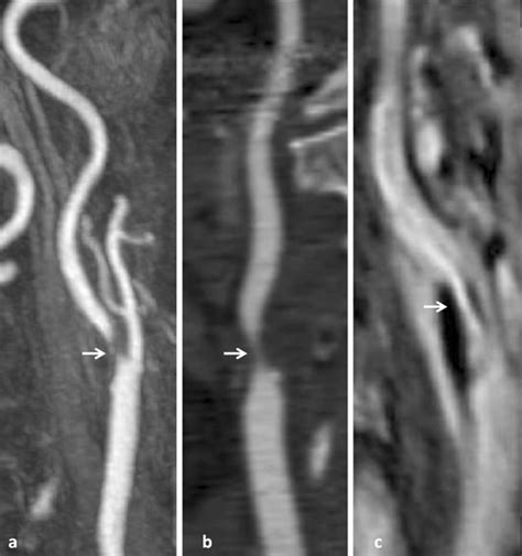 5 A Contrast Enhanced MRA Shows A Long Plaque Localized At Carotid
