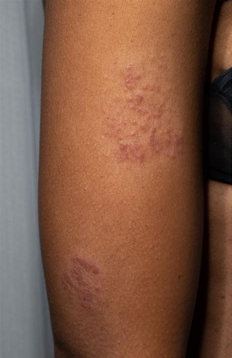 Sarcoidosis Skin Rash Lesions