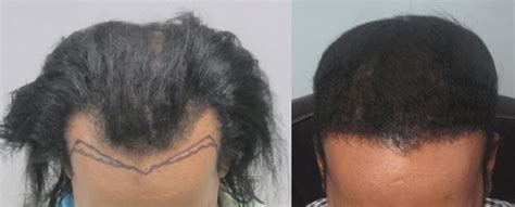 Maybe you would like to learn more about one of these? African American Hair Transplant