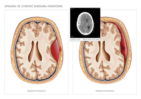 Intracranial epidural hematoma (edh) refers to bleeding between the dura mater and the calvarium. Craniotomy and Fixation of Occipital Fracture | High ...