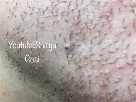An ingrown hair is possible and nothing to worry about really, however the fact that you have a bump on your testicle regardless of the cause needs to. What do you guys think is this? Blackhead or Ingrown hair ...