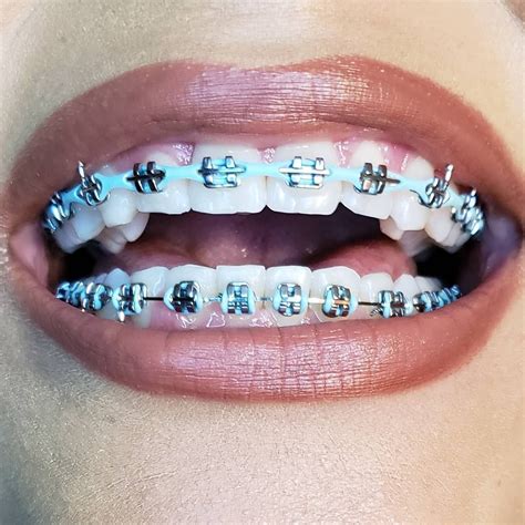 Pin On Teeth Braces