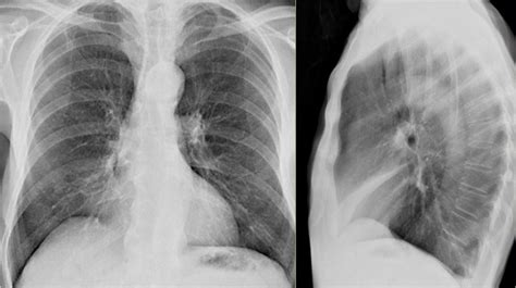 Right Middle Lobe Atelectasis First Study The X Rays Grepmed