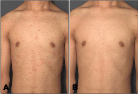 Clinical Features Of Pityriasis Rosea Before A And After B Uva1