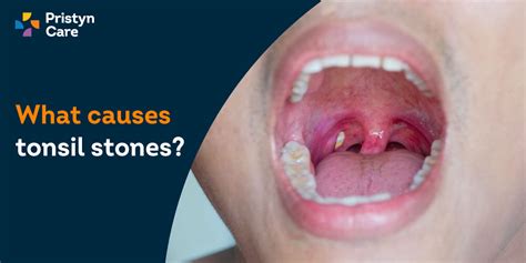How To Get Rid Of Tonsil Stones - Creativeconversation4