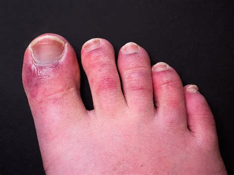 ‘covid Toes Are Caused By Coronavirus Infecting The Lining Of Blood