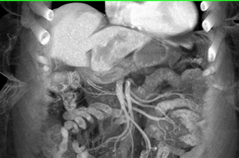 Nodes Near Head Of Pancreas Gastrointestinal Case Studies Ctisus Ct