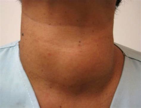 Radiofrequency Ablation Of Thyroid Nodules General Surgery