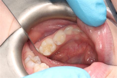 Treatment Of Caries In Primary Molars Using The Hall Technique A Tool