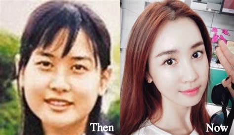 lee da hae plastic surgery before and after photos latest plastic 30225 hot sex picture
