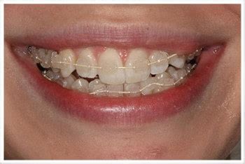 See more of do it yourself braces in mariveles on facebook. Do It Yourself Braces - Harris Dental Boutique