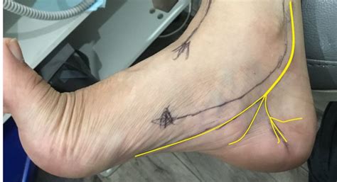 Tarsal Tunnel Syndrome Posterior Tibial Neuralgia Ankle Foot And