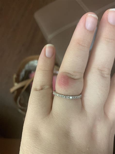 What Is This Bump On My Finger It Looks Bubbly Up Clo Vrogue Co