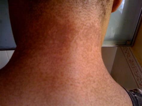 Brown Spots On Neck Pictures Photos