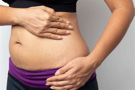 Stretch Marks Weight Loss Everything You Need To Know SOG Health