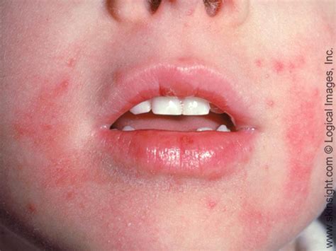 Eczema In Children Atopic Dermatitis In Children Causes Triggers