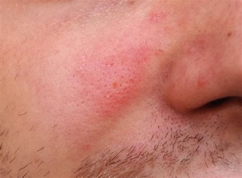 What Is This Red Blot On My Face How Can I Cure It Dermatology