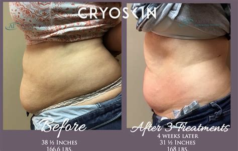 Cryoskin Slimming Abs Before And After 2 About Face Anti