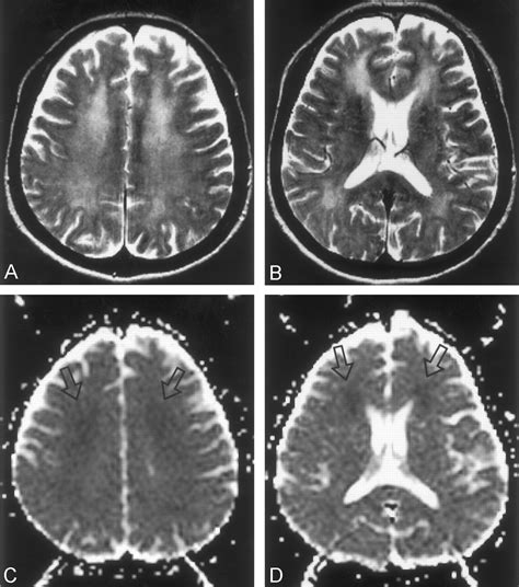 Delayed Encephalopathy Of Acute Carbon Monoxide Intoxication