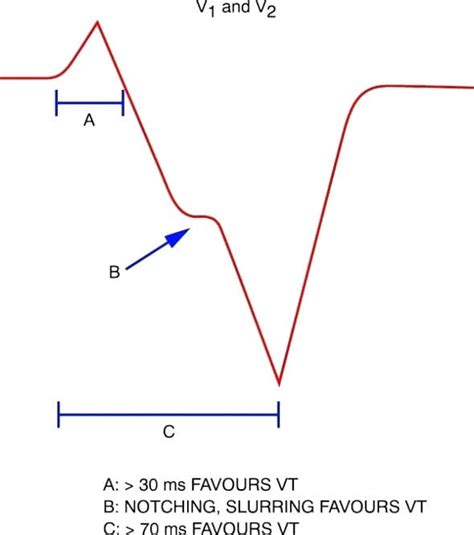 Vt Versus Svt • Litfl Medical Blog • Ecg Library Basics