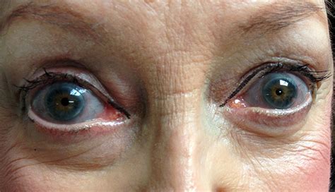 Clinical Challenge Blue Sclera In A Patient With Skeletal