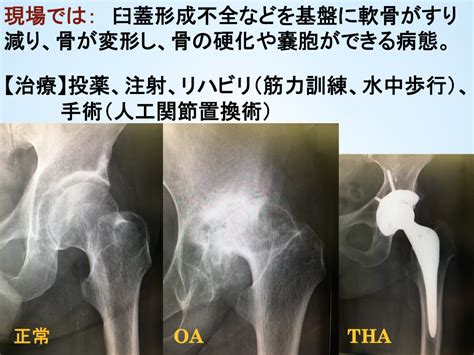 » 変形性股関節症