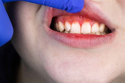 Periodontal Disease Or Gum Disease What Is It And How Do We Treat It