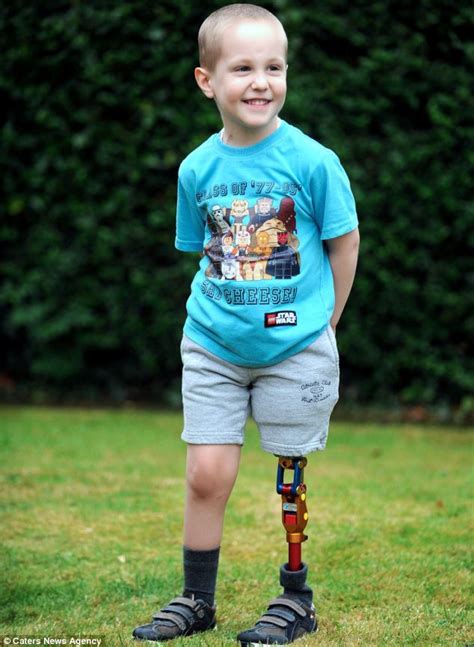 Boy Who Lost Leg To Cancer First Child In Uk To Get Robot Leg Daily