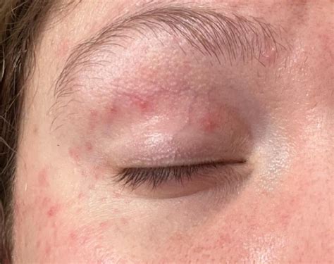 Eye Rash Celiac Related Rceliac