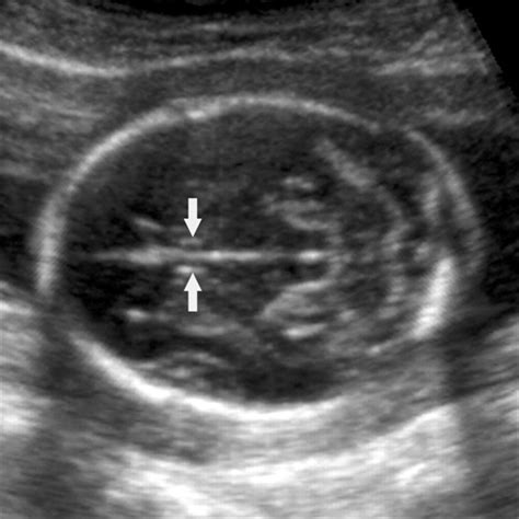 The Cavum Septi Pellucidi Winter 2010 Journal Of Ultrasound In