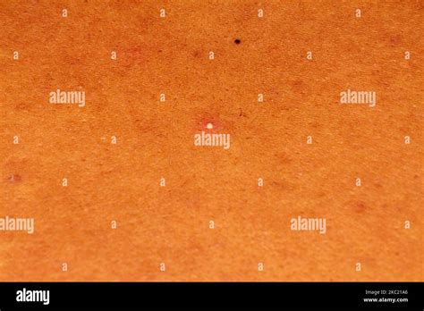 Human Skin Texture Pimples On Skin Micro Photo Close Up Photo Stock