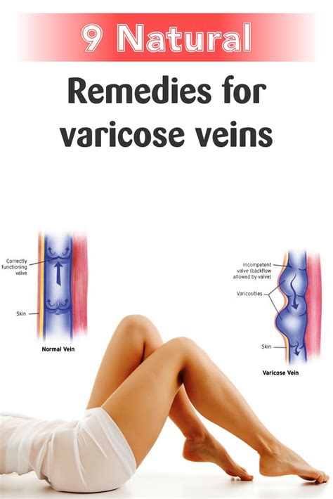 9 Natural Remedies For Varicose Veins Varicose Vein Remedy Varicose