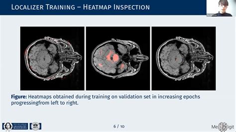 Localization Of The Locus Coeruleus In Mri Via Coordinate Regression Youtube