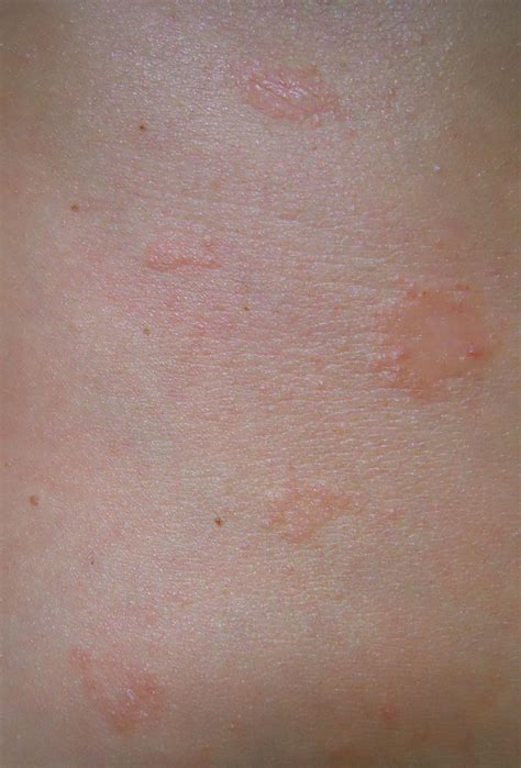 Itchy Rash On Stomach Belly Button Rash Causes And Symptoms Medicaverse A Rash Is A