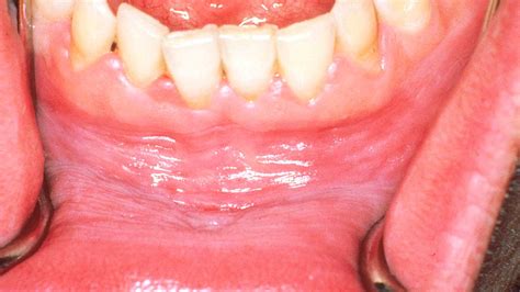 White Gums Causes Treatments And More