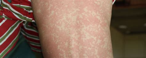 Maculopapular Rash Causes Appearance And Treatment
