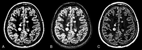 Synthetic Mri In The Detection Of Multiple Sclerosis Plaques Ajnr Blog
