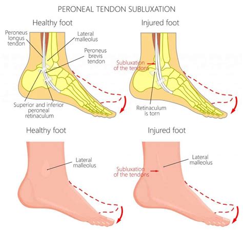 Peroneal Tendon Subluxation Ankle Tendon Subluxation