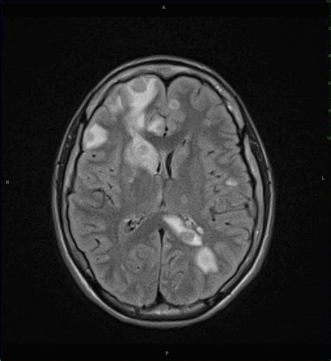 Brain Abscesses Multiple Neuro Mr Case Studies Ctisus Ct Scanning