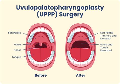 What Is Uppp Surgery Sleep Foundation