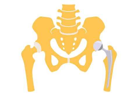Hip Replacement Surgery Images Stock Photos Pictures And Royalty Free