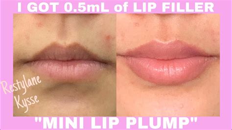 Getting Lip Filler For The First Time 05ml Restylane Kysse Mini Lip Filler Youtube
