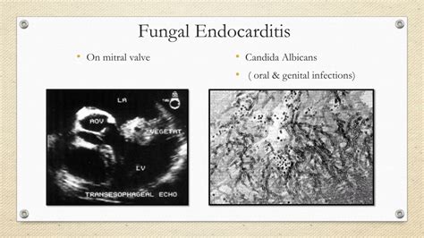 Ppt Infective Endocarditis A Disease In Disguise Powerpoint