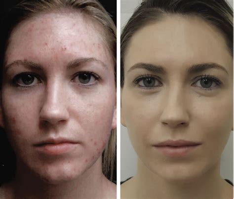 Albums 90 Images Dermabrasion For Acne Scars Before And After Pictures