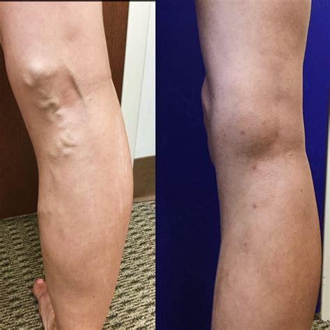 Varicose Veins And Cold Weather Vein Specialists Of The Carolinas