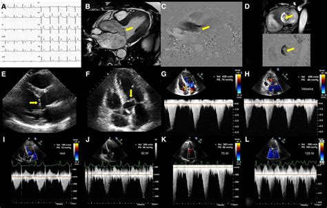 Left Ventricular Outflow Tract Obstruction Due To Elongation Of